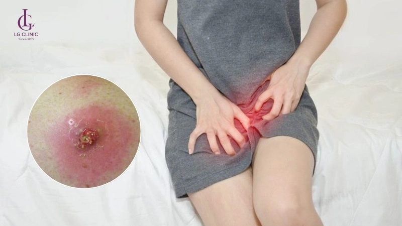 để lại sẹo sau khi khỏi
