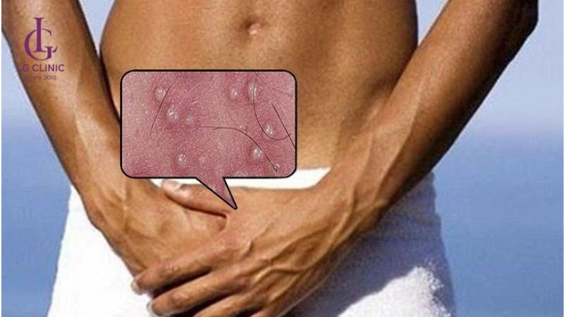 vệ sinh vùng kín khi bị viêm nang lông ở nam