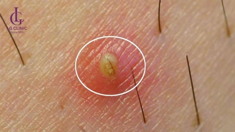 vùng kín xuất hiện mụn màu vàng