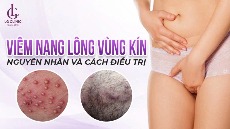viêm nang lông vùng kín là gì