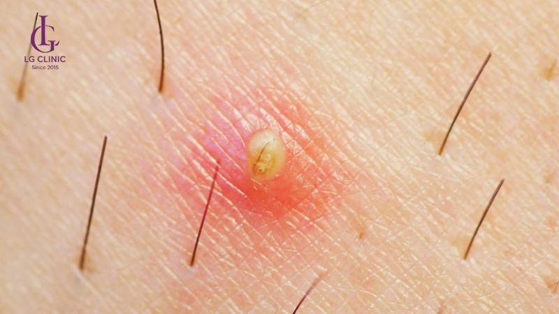 wax lông gây lông mọc ngược