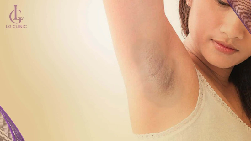 wax lông nách có bị thâm không