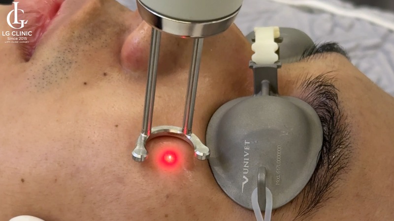 trị thâm mụn bằng laser