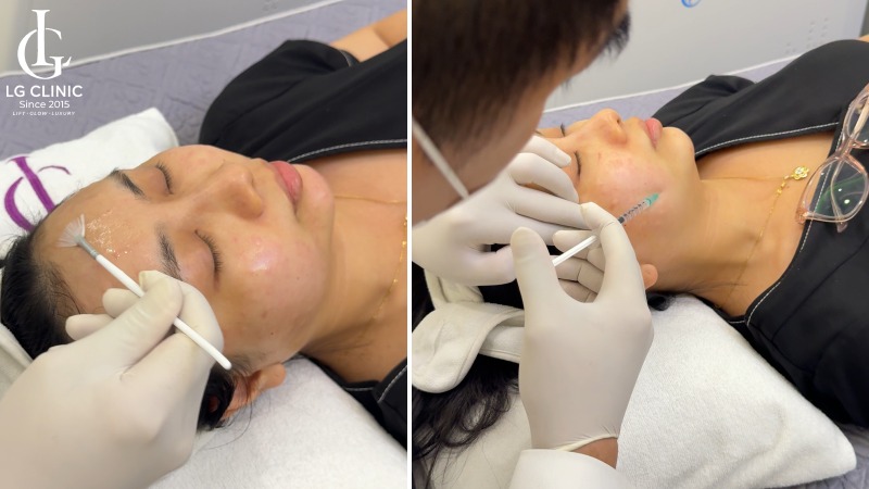 trị thâm mụn bằng laser