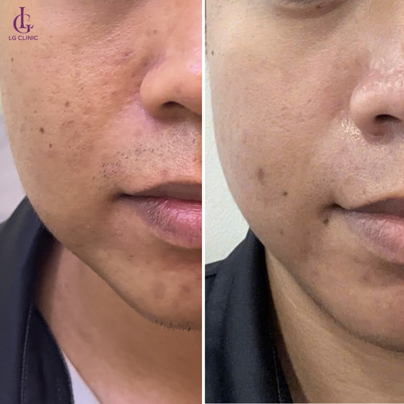 trị thâm mụn bằng laser