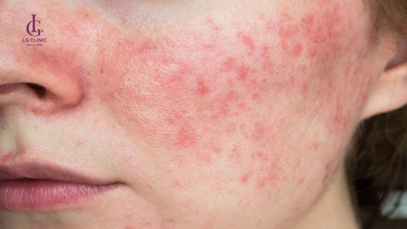 kích ưng sau khi bắn laser