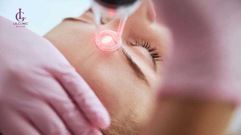 bắn laser là lựa chọn hàng đầu