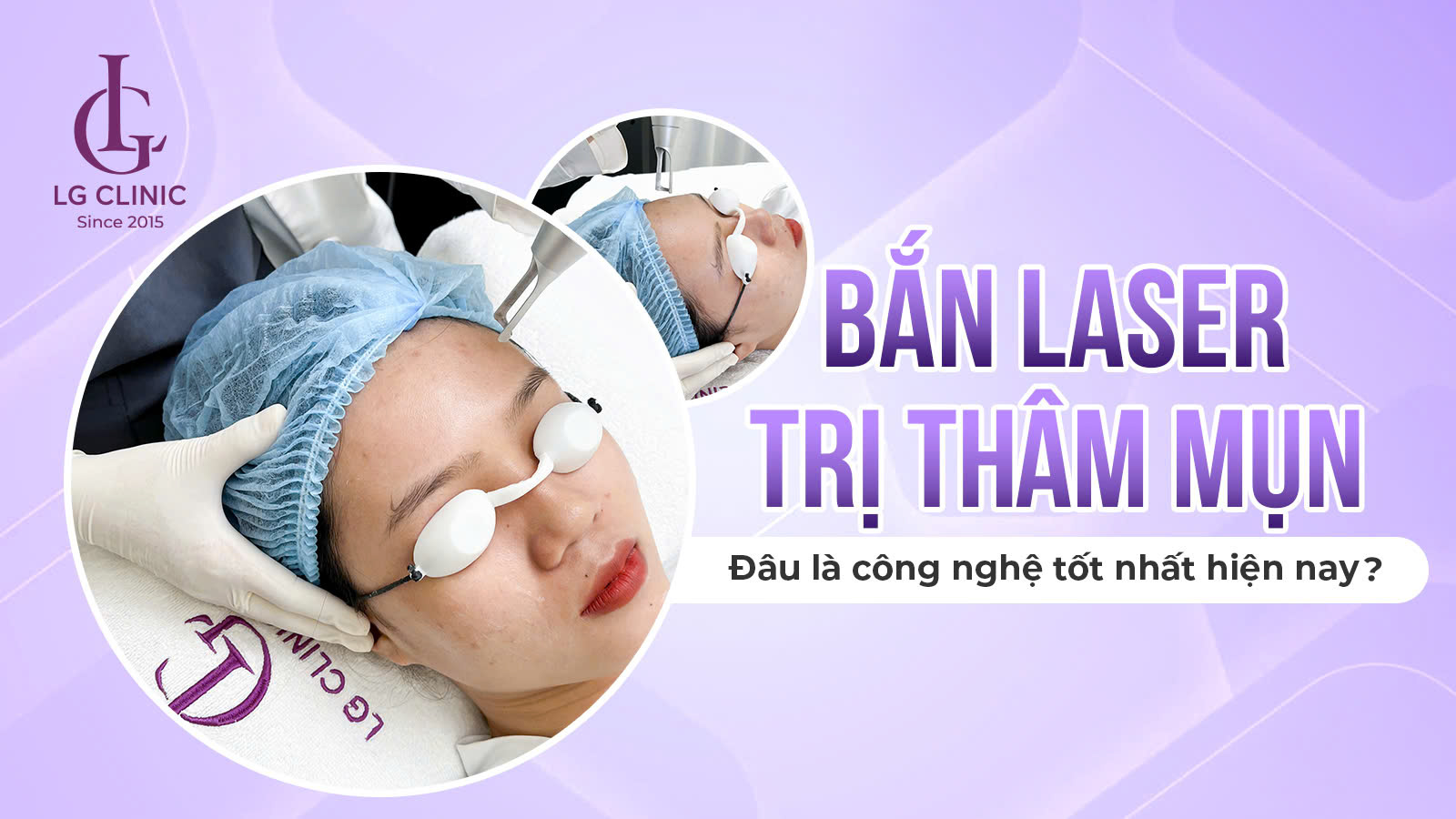 bắn laser trị thâm mụn