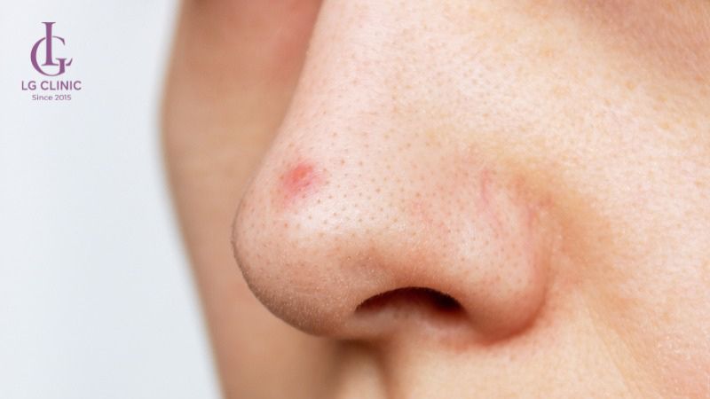 bã nhờn là nguyên nhân gây mụn thâm