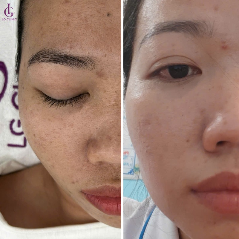 cách trị thâm mụn bằng sữa chua không đường