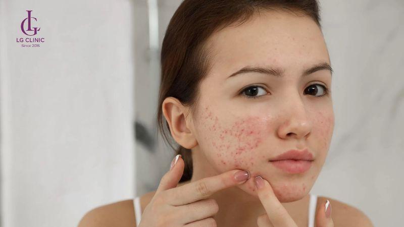 nặn mụn không đúng cách làm thâm nặng hơn