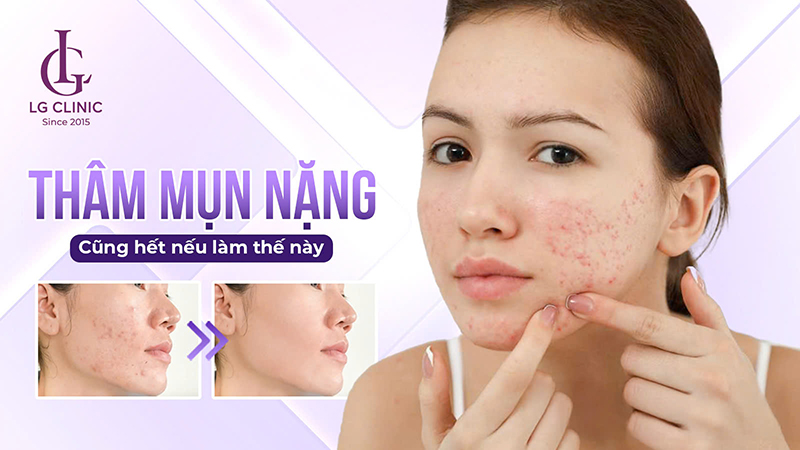 cách trị thâm mụn nặng