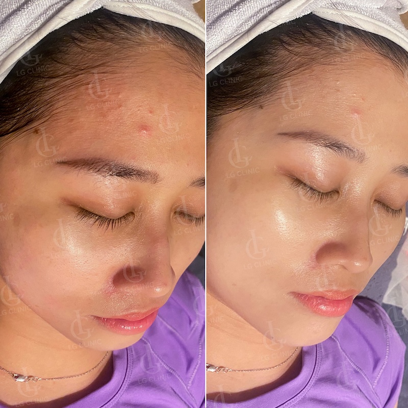 kết quả tiêm bap 2