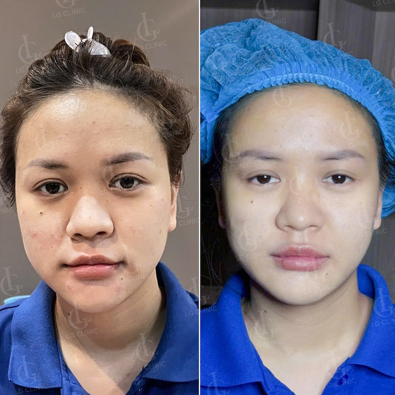 kết quả tiêm bap 2