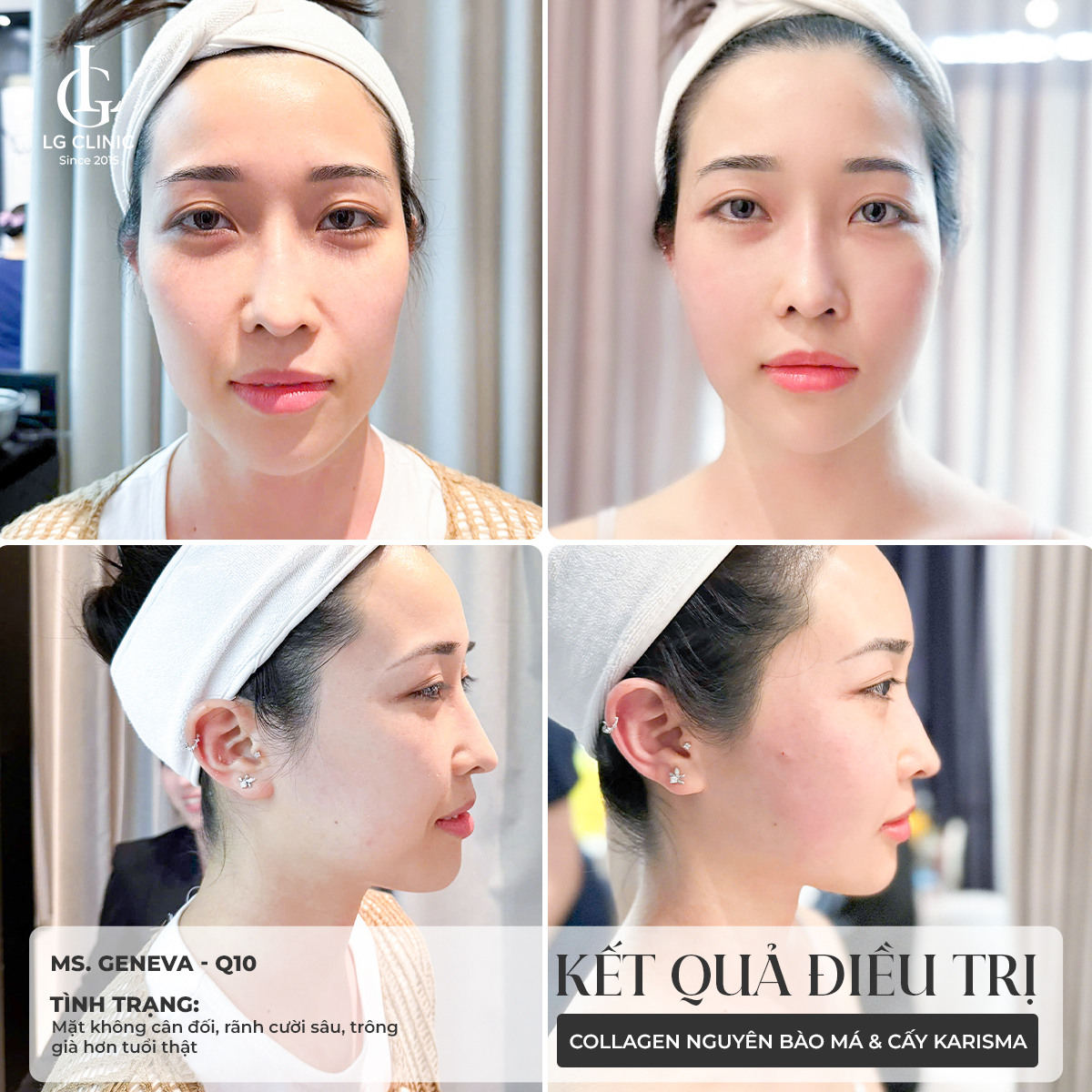 kết quả liệu trình tiêm bap karisma tại lg clinic