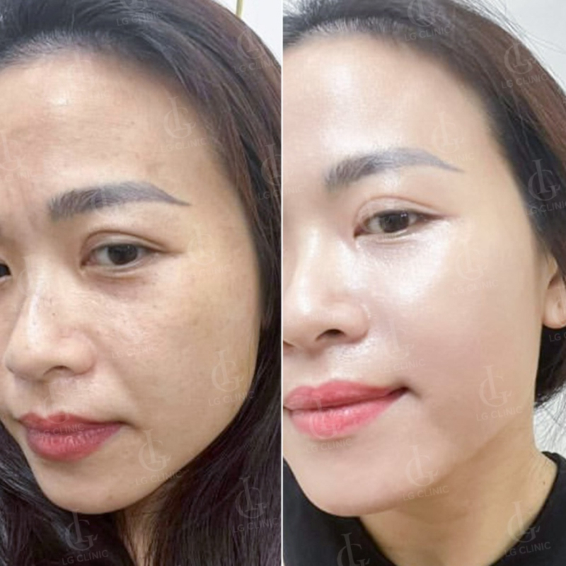 kết quả tiêm bap tại lg clinic tại tp hcm