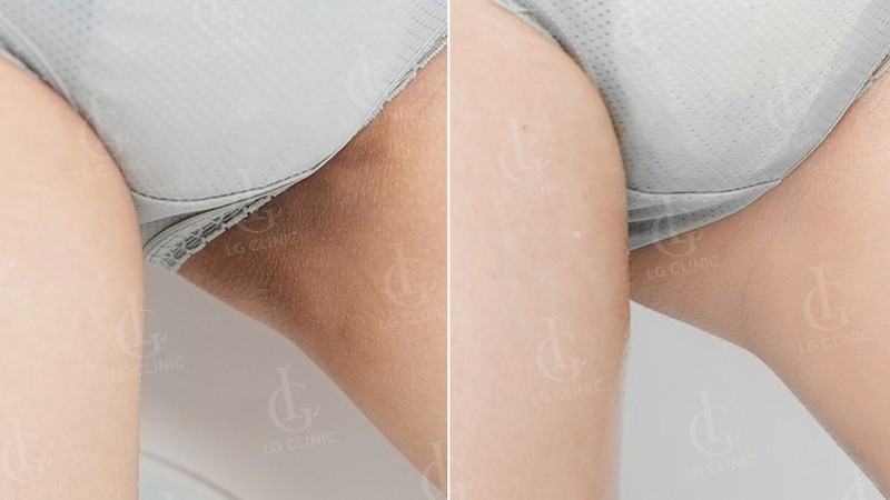 kết quả điều trị với dịch vụ trị thâm bẹn háng 3 - trị thâm bằng laser