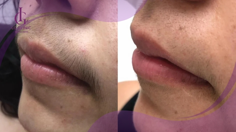hình ảnh sau khi triệt râu vĩnh viễn tại LG Clinic