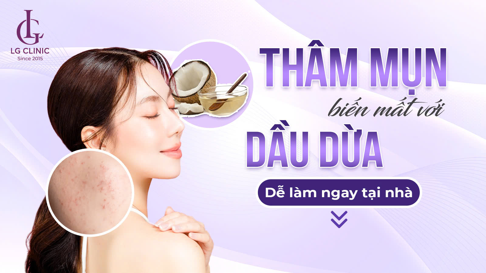 làm mờ vết thâm mụn bằng dầu dừa