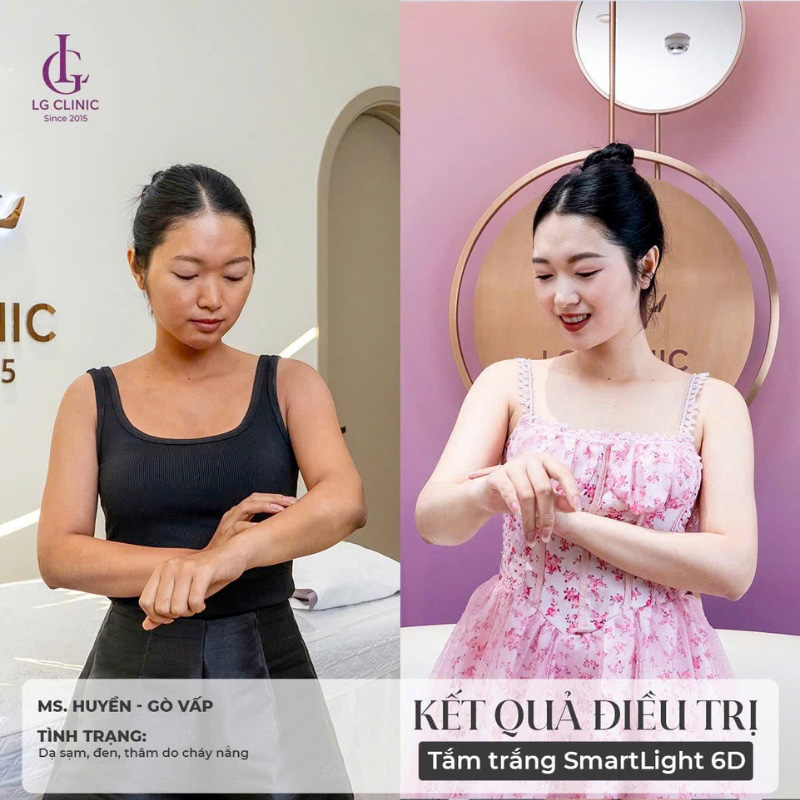 Ms Huyền trước và sau khi tắm trắng tại LG Clinic
