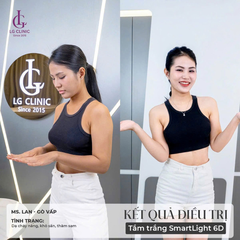 Chị Như Lan trước và sau khi tắm trắng tại LG Clinic