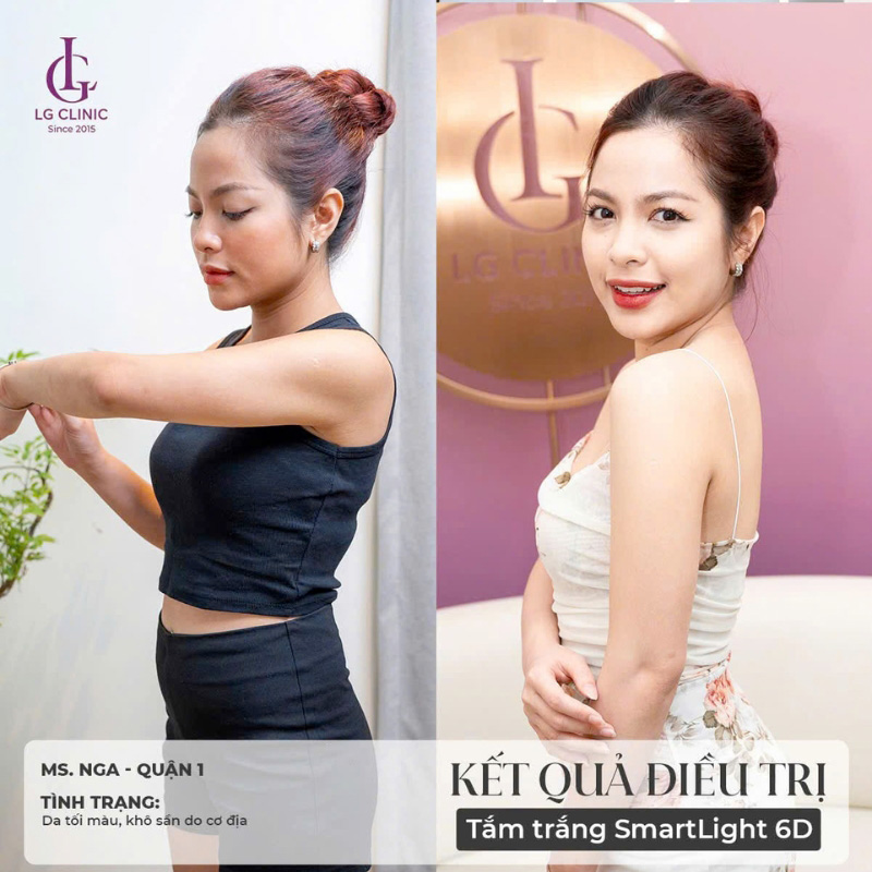 Chị Nga trước và sau khi tắm trắng tại LG Clinic