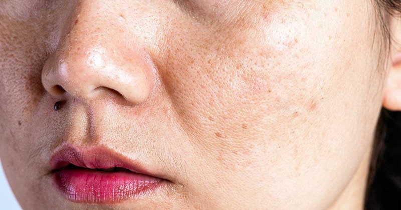 da khô ráp phù hợp tiêm bap 5 điểm