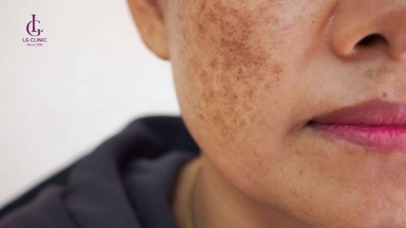 Tăng sắc tố da