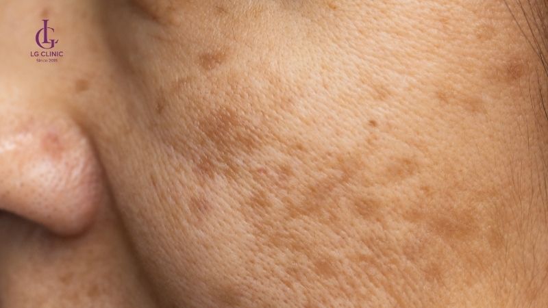 Da có các đốm nâu thâm đen trên mặt