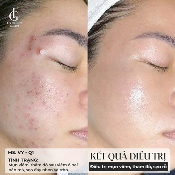 kết quả điều trị thâm mụn 1