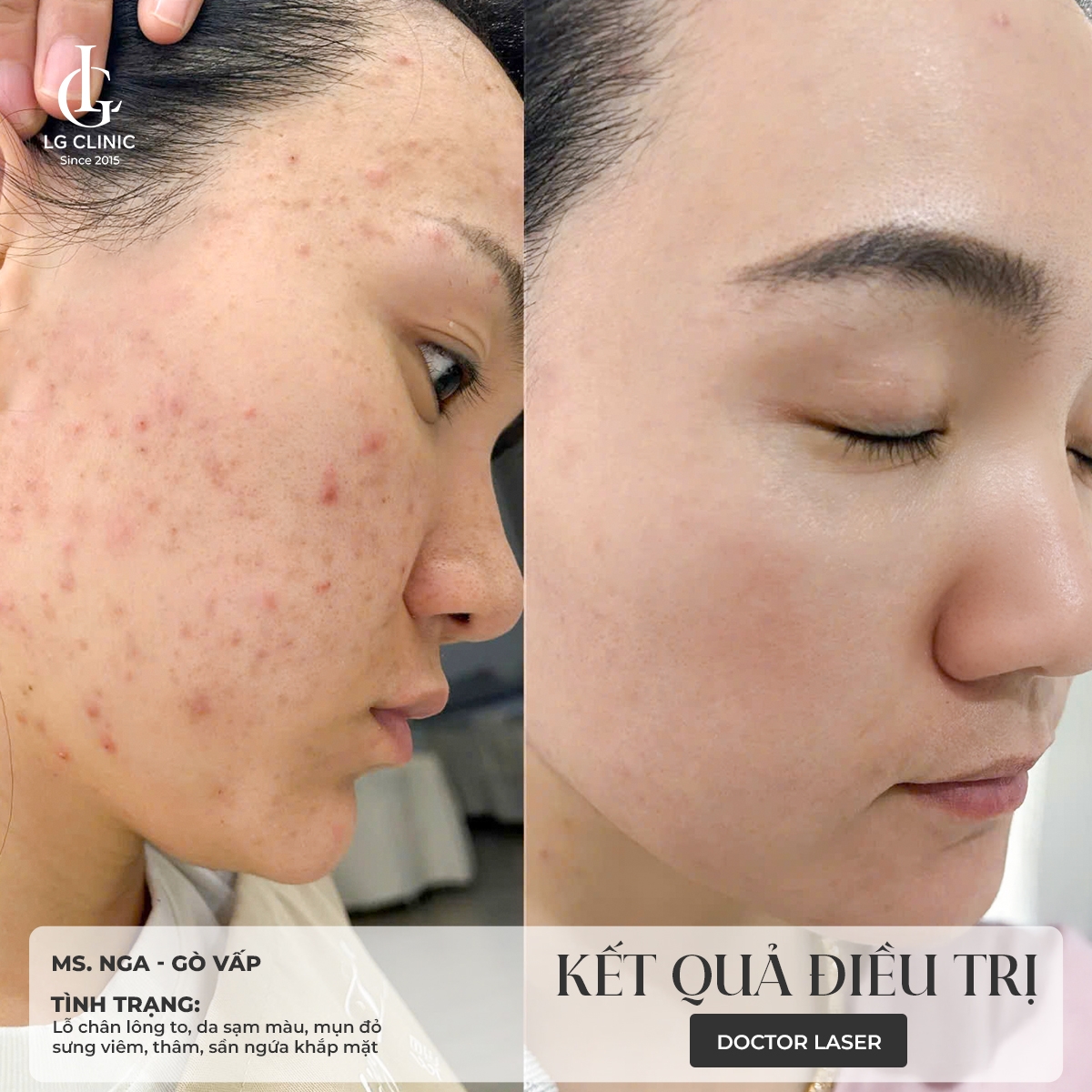 kết quả điều trị mụn 2