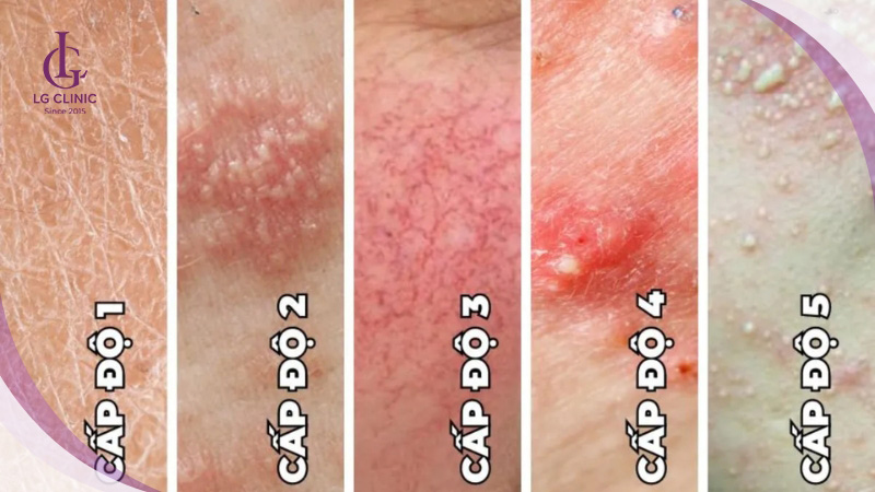 Hậu quả của tắm trắng giá rẻ