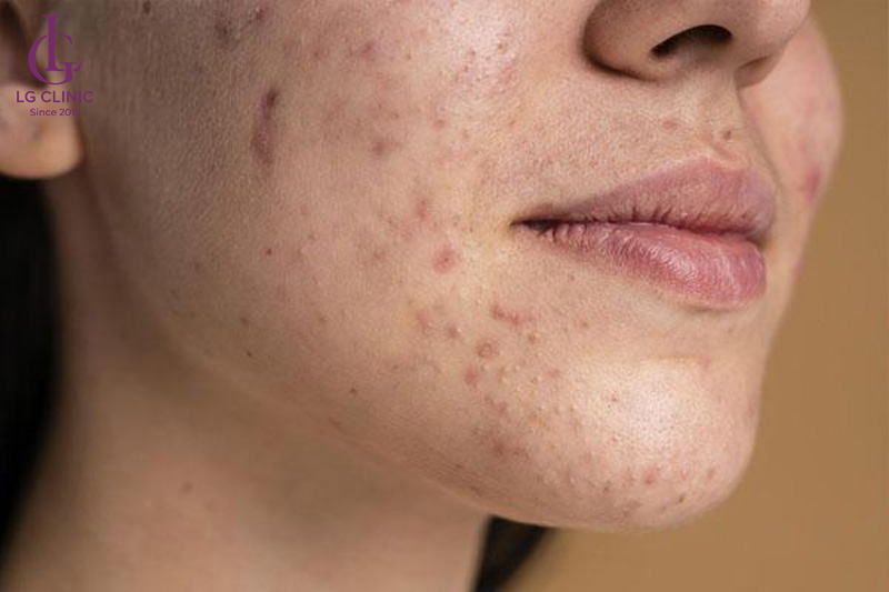 sản sinh melanin dư thừa
