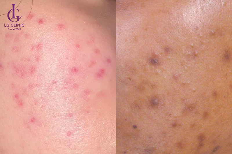 khác nhau giữa thâm mụn đỏ và thâm mụn đen