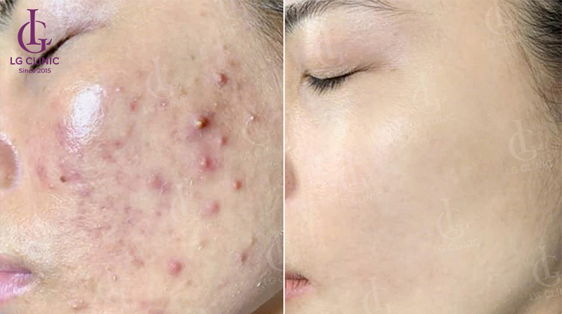 trị hoàn toàn thâm mụn tại lg clinic