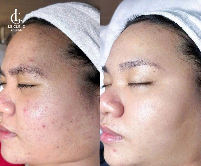 điều trị thâm mụn đen tại lg clinic