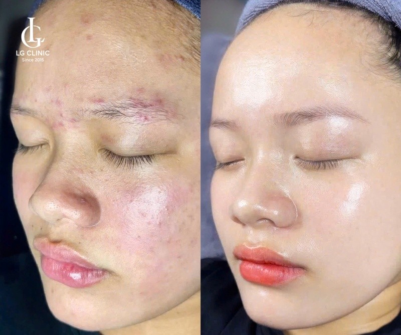 điều trị thâm mụn đen tại lg clinic