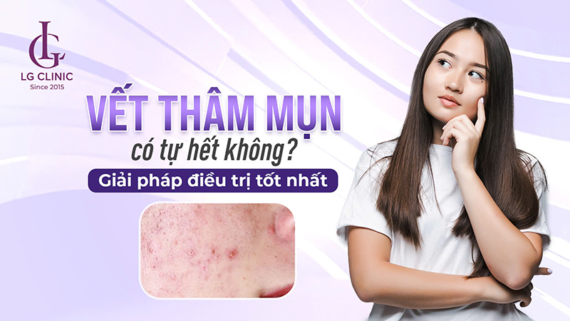 vết thâm mụn có tự hết không