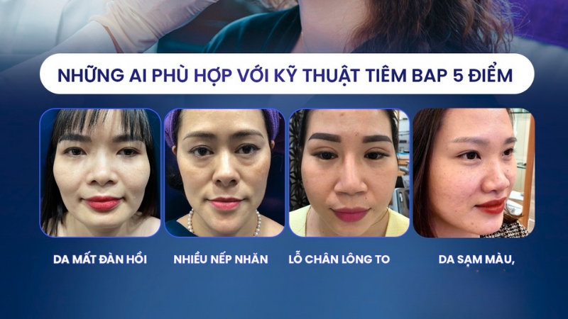 da có tình trạng lão hóa có thể tiêm bap 5 điểm