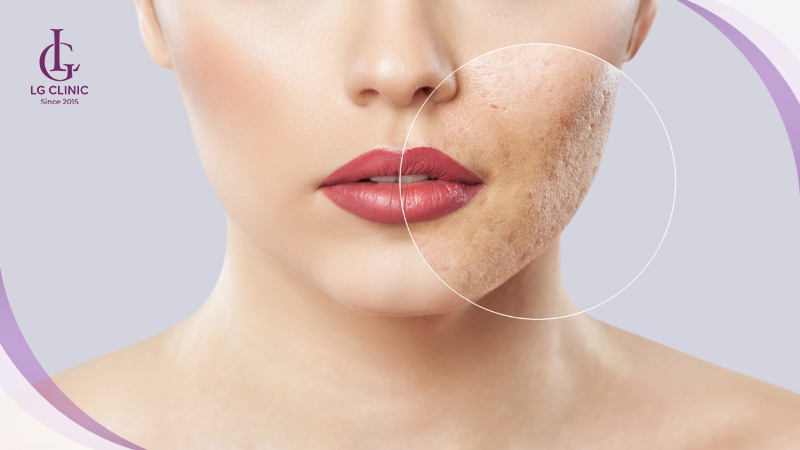 Rejuran S Acne Scars ít gây tác dụng phụ