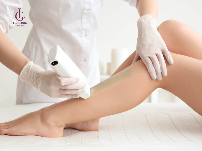 triệt lông bằng laser là gì