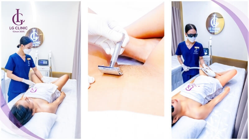 triệt lông bikini công nghệ cao tại LG Clinic