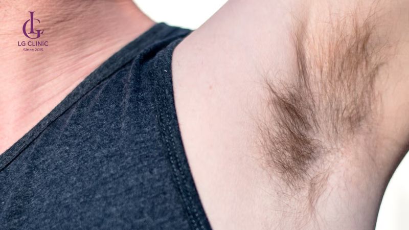 triệt lông người có lông nách dày và rậm