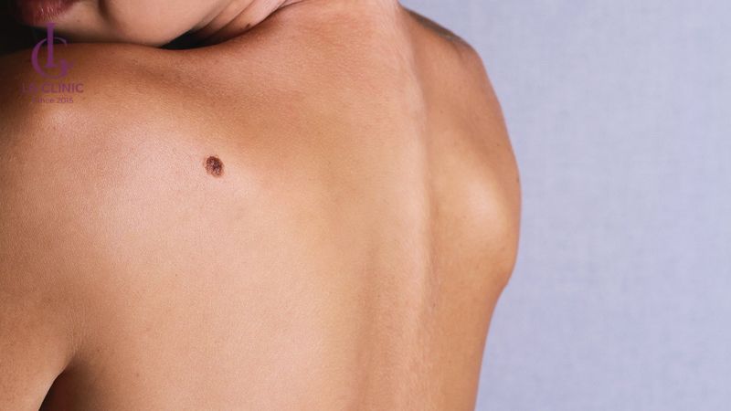 Ung thư da tại một vị trí