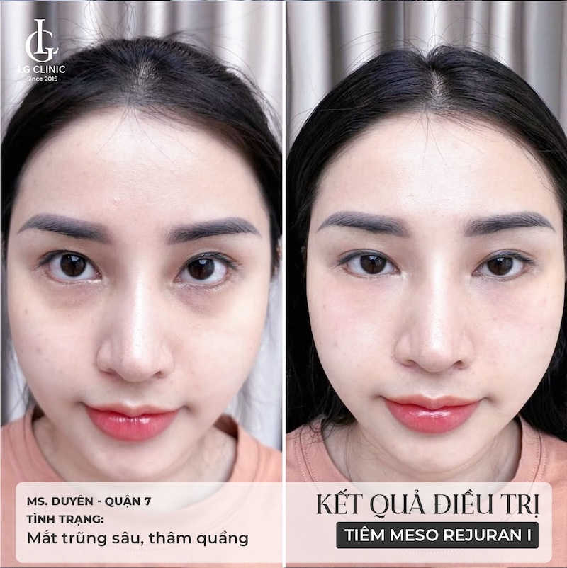 kết quả tiêm meso tại LG Clinic