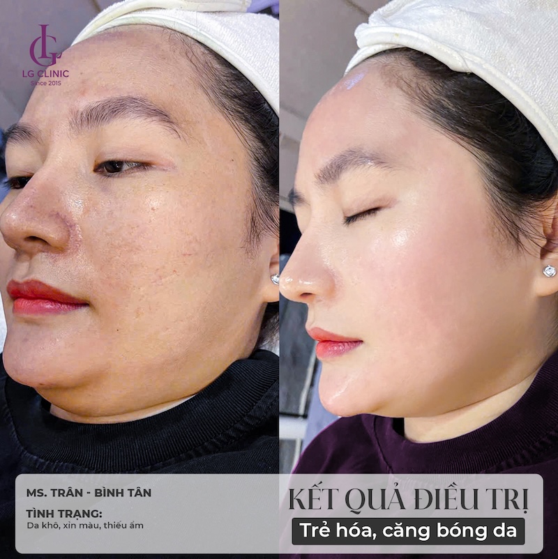 kết quả tiêm meso tại LG Clinic