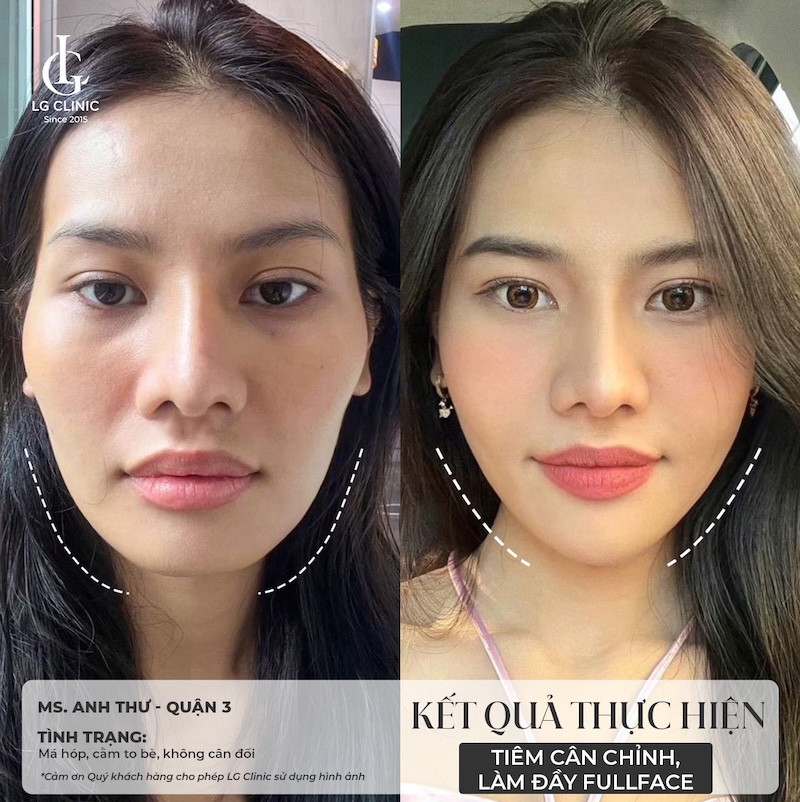 kết quả tiêm filler tại LG Clinic