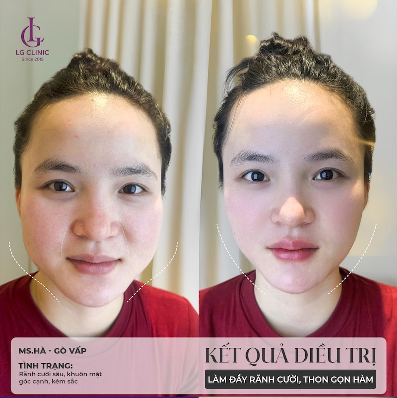 kết quả tiêm filler tại LG Clinic