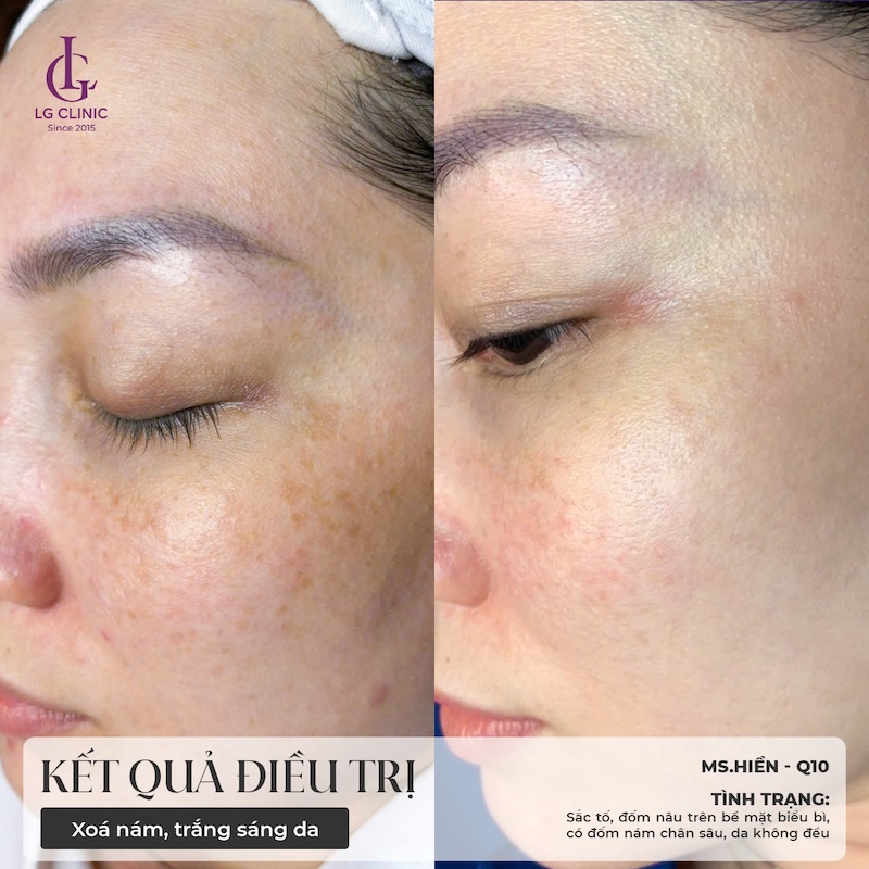 kết quả điều trị meso trị nám 1