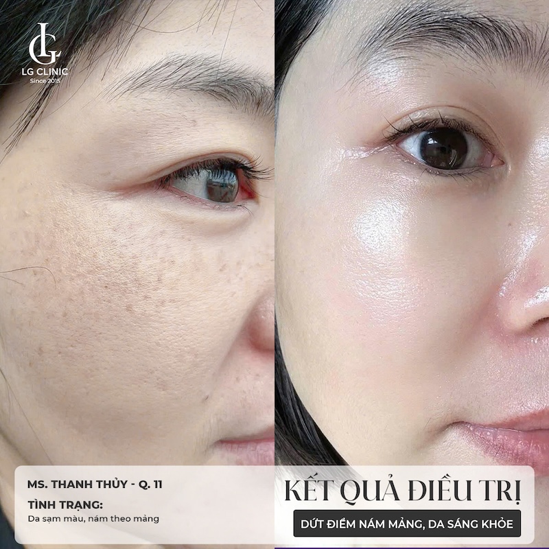 kết quả điều trị meso trị nám 2